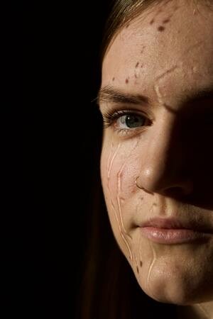 Atrophic Scars