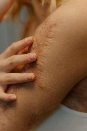 Hypertrophic Scars