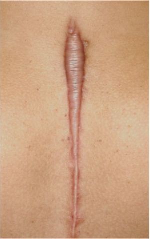 Keloid Scars